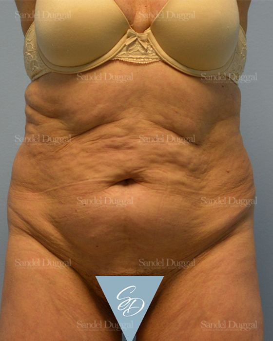 Tummy Tuck before, case 1729