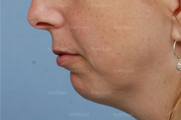 Chin Augmentation before, case 1474