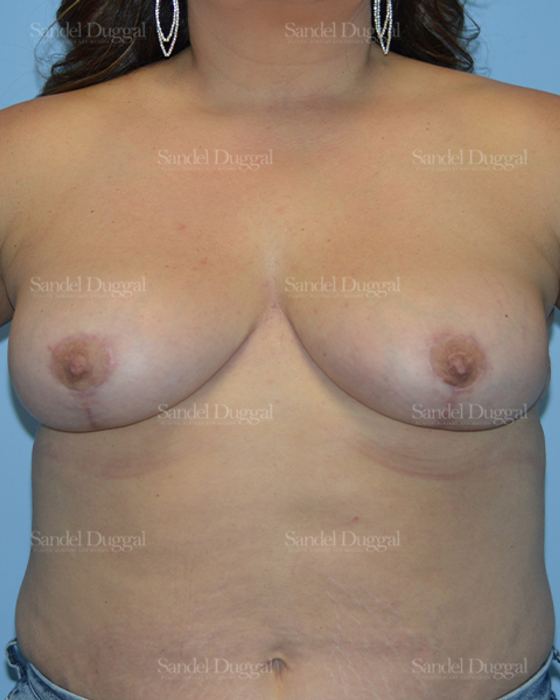 Breast Lift after, case 3280