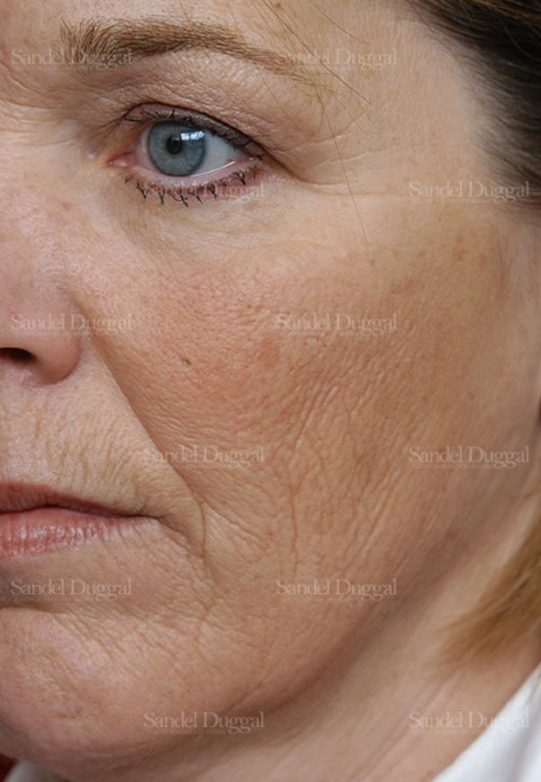 Laser Skin Resurfacing before, case 2981