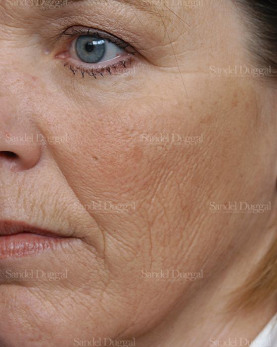 Laser Skin Resurfacing before, case 2981