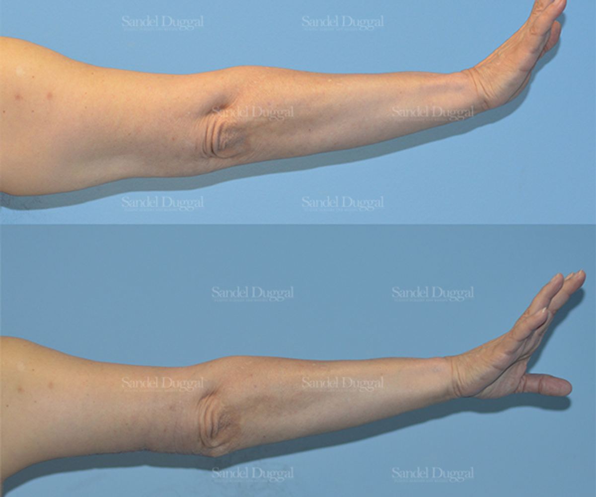 Brachioplasty before and after, case 2103