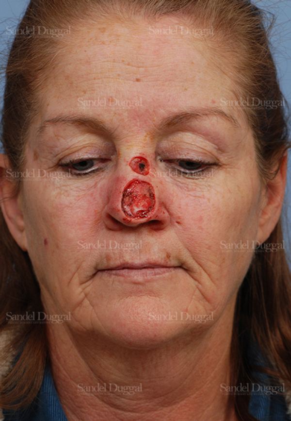 Reconstruction after Mohs before, case 2799