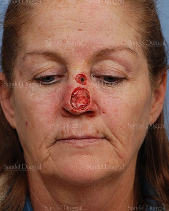 Reconstruction after Mohs before, case 2799