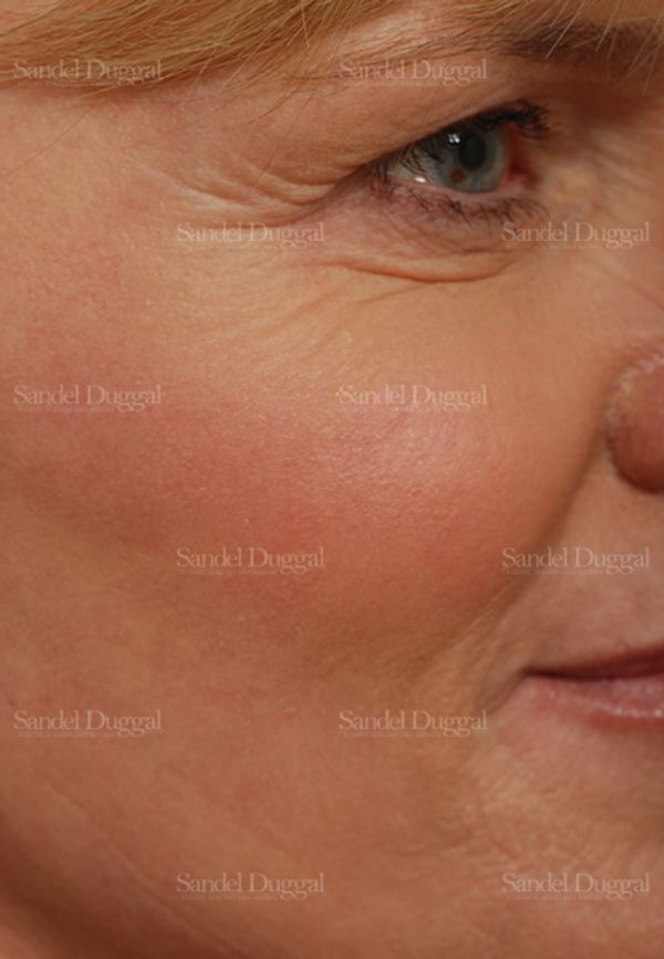Laser Skin Resurfacing after, case 2955