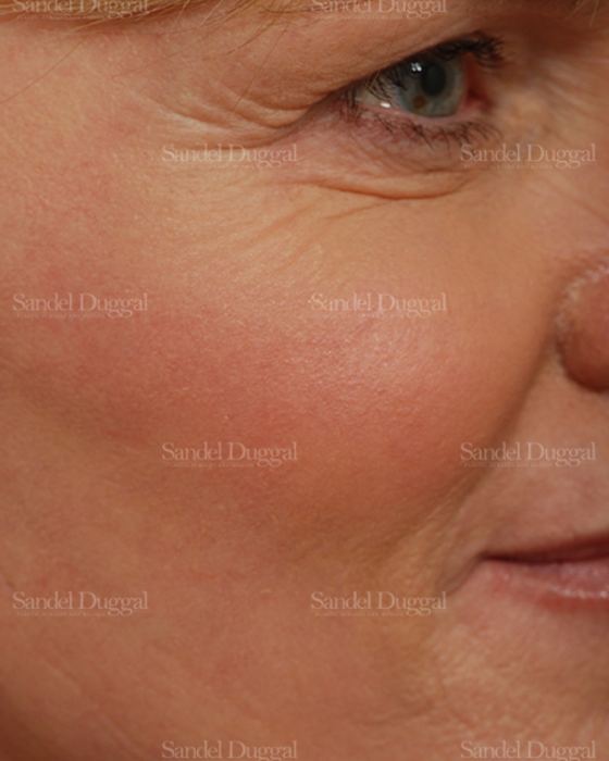 Laser Skin Resurfacing after, case 2955