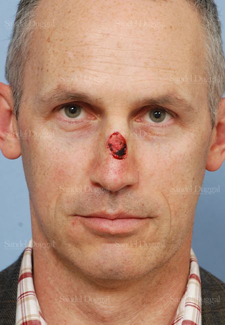 Reconstruction after Mohs before, case 2805