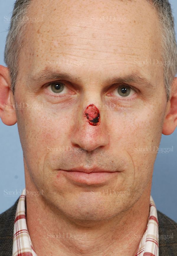 Reconstruction after Mohs before, case 2805