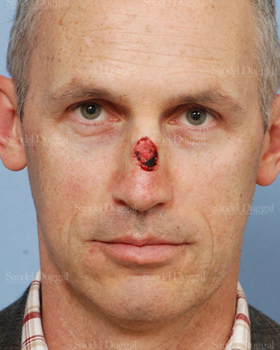 Reconstruction after Mohs before, case 2805