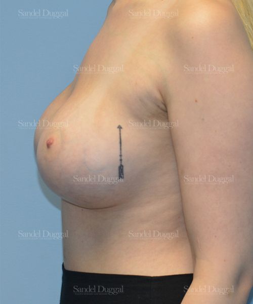 Breast Augmentation after, case 3129