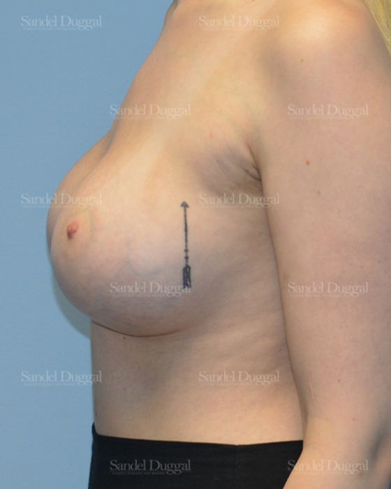 Breast Augmentation after, case 3129