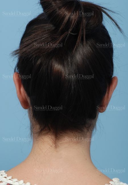 Otoplasty after, case 4078