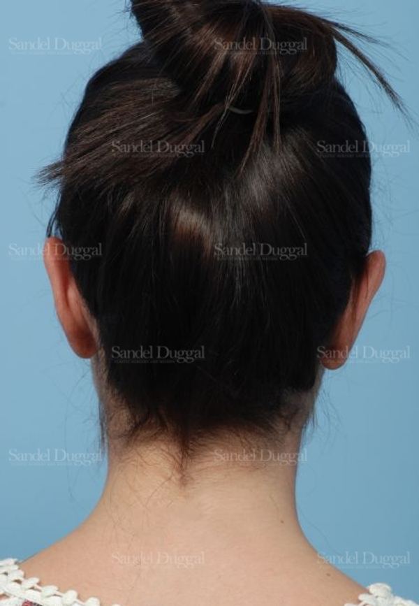 Otoplasty after, case 4078