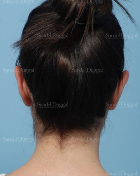 Otoplasty after, case 4078
