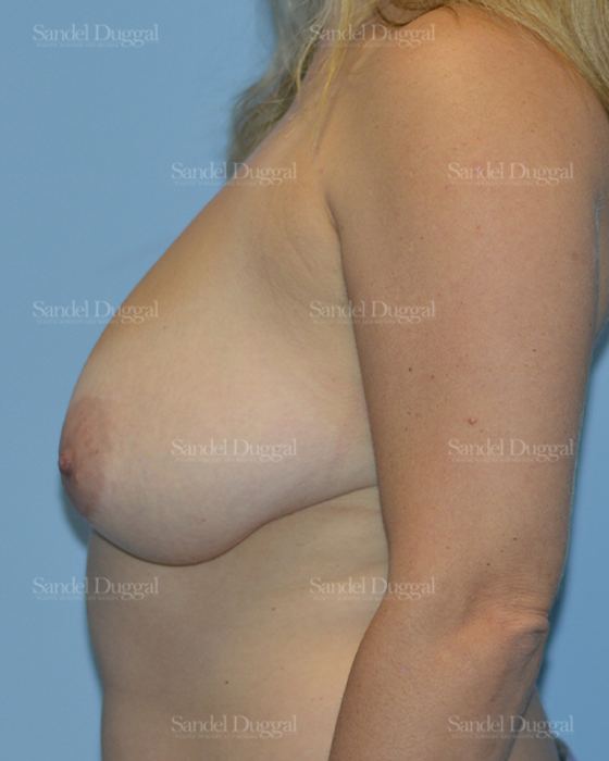 Breast Lift before, case 3308