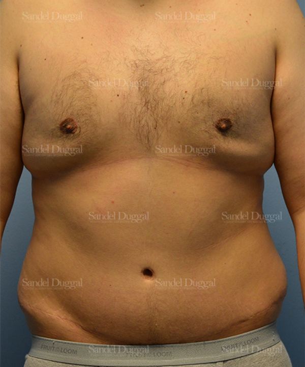 Liposuction — Legs & Flanks before, case 2545