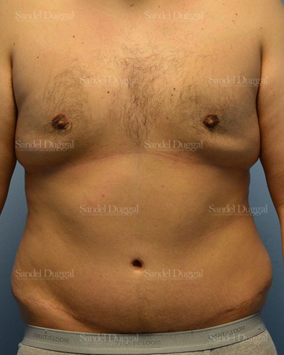 Liposuction — Legs & Flanks before, case 2545