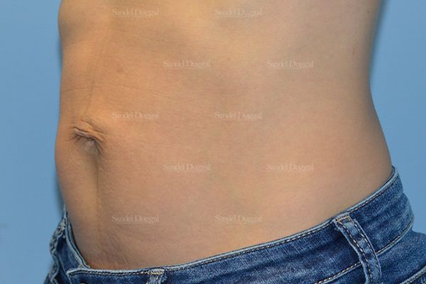 Umbilicoplasty before, case 1457