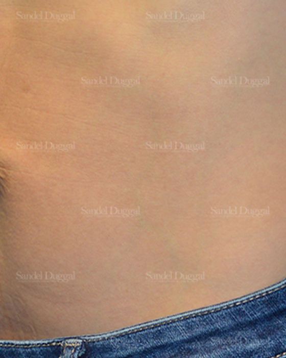 Umbilicoplasty before, case 1457