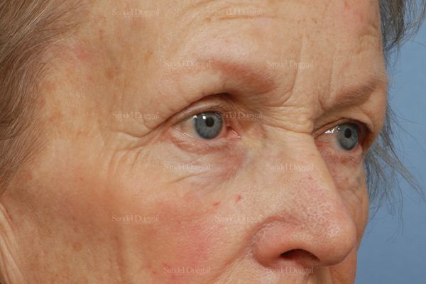 Eyelid Rejuvenation before, case 1951