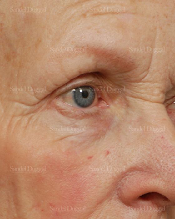 Eyelid Rejuvenation before, case 1951