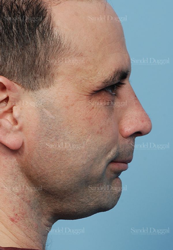 Rhinoplasty after, case 2909