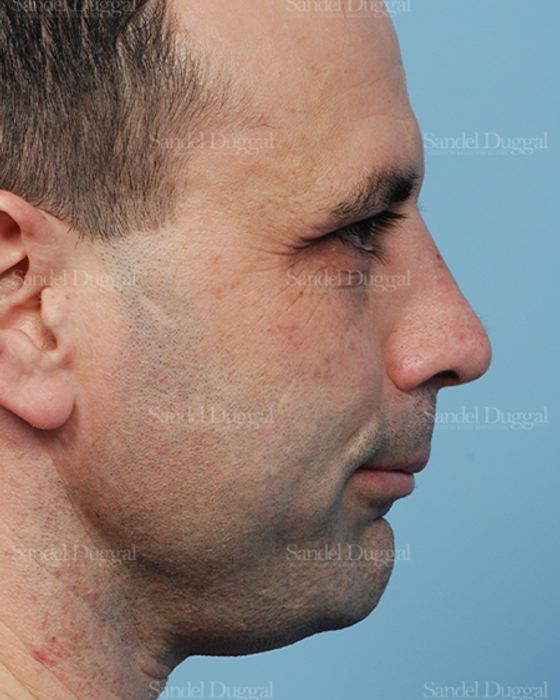 Rhinoplasty after, case 2909
