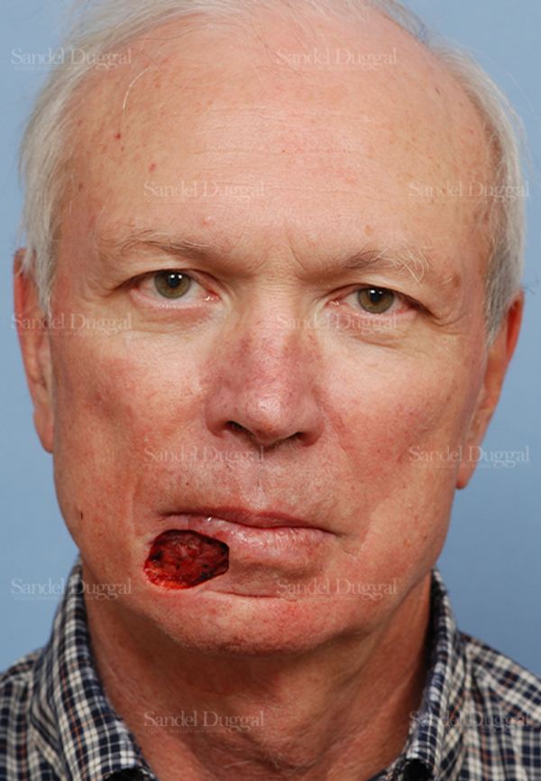 Reconstruction after Mohs before, case 2775