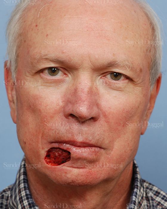 Reconstruction after Mohs before, case 2775