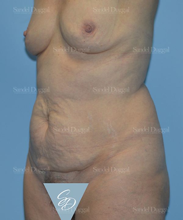 Tummy Tuck before, case 1687