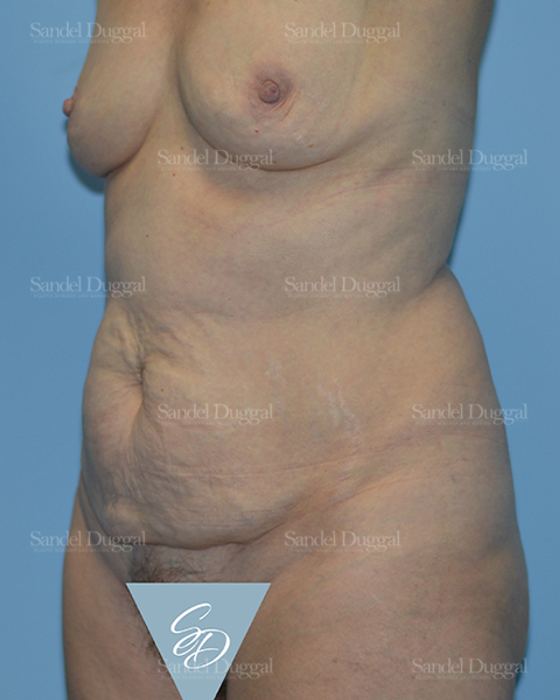 Tummy Tuck before, case 1687