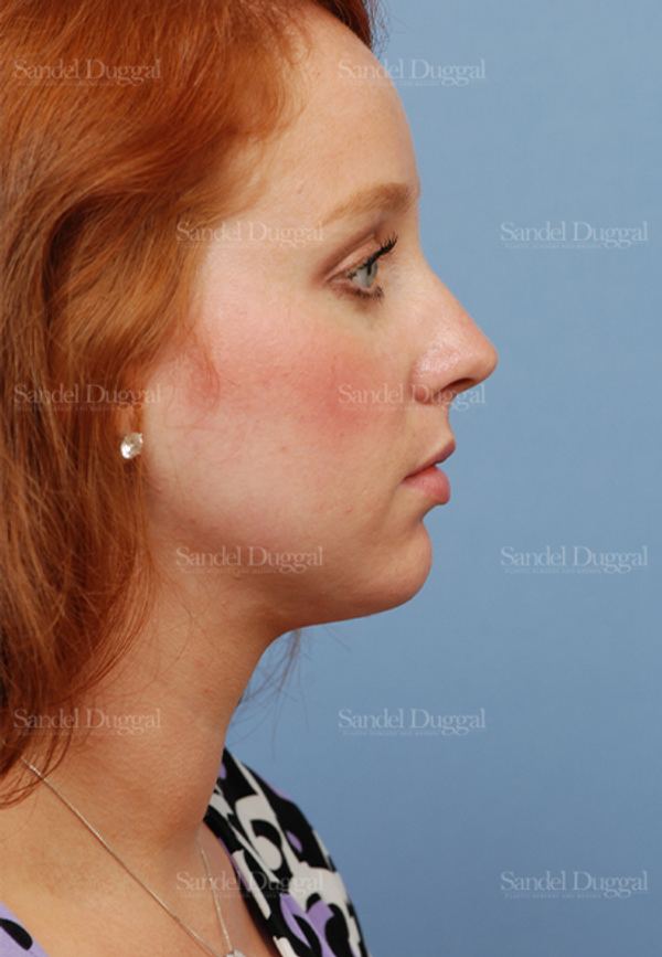 Neck & Chin Liposuction after, case 2027