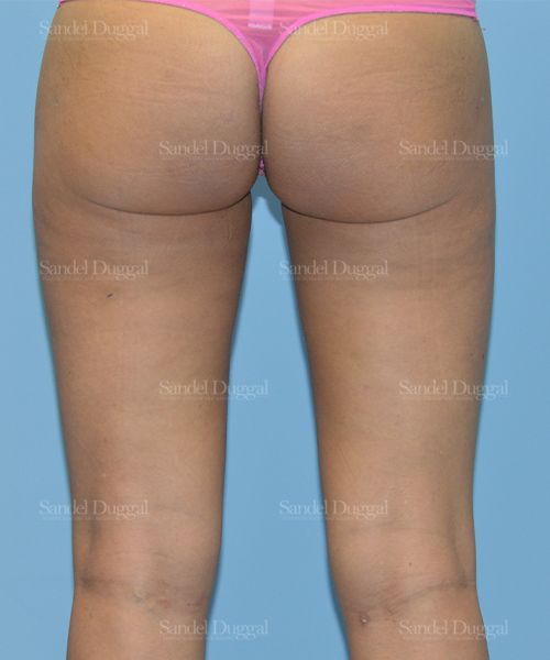 Liposuction — Legs & Flanks after, case 2540