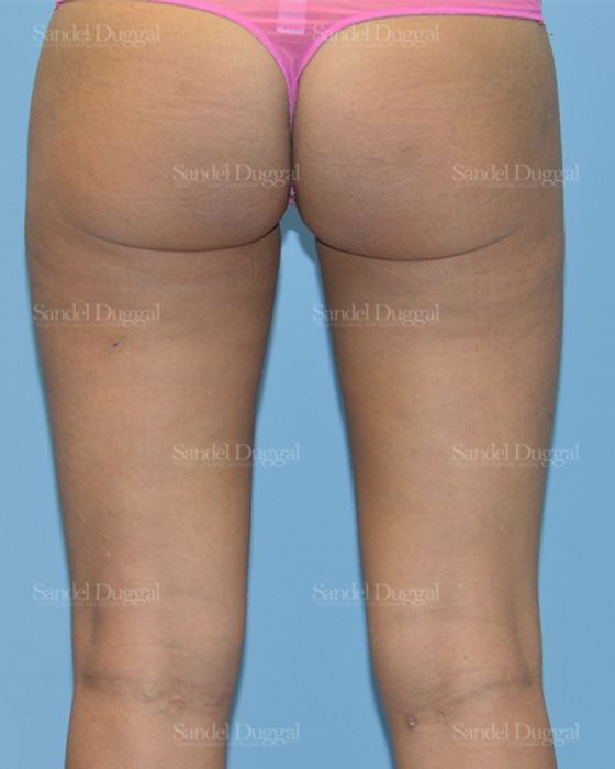 Liposuction — Legs & Flanks after, case 2540