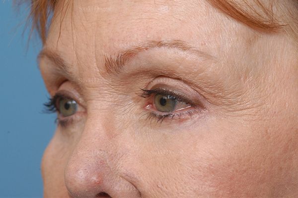 Eyelid Rejuvenation after, case 1930