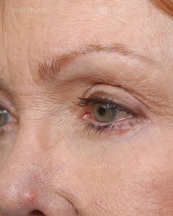 Eyelid Rejuvenation after, case 1930