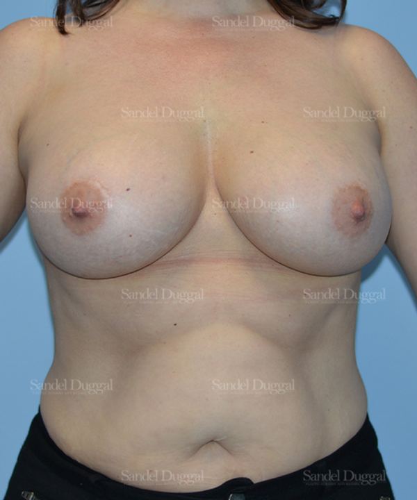 Breast Augmentation after, case 3206