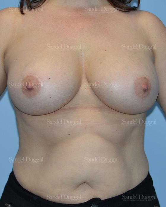 Breast Augmentation after, case 3206