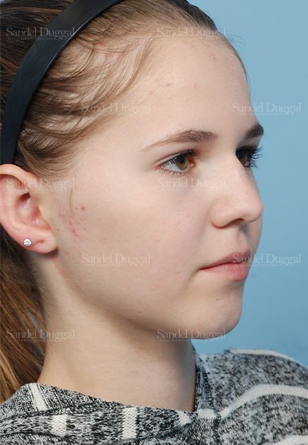Otoplasty after, case 2598