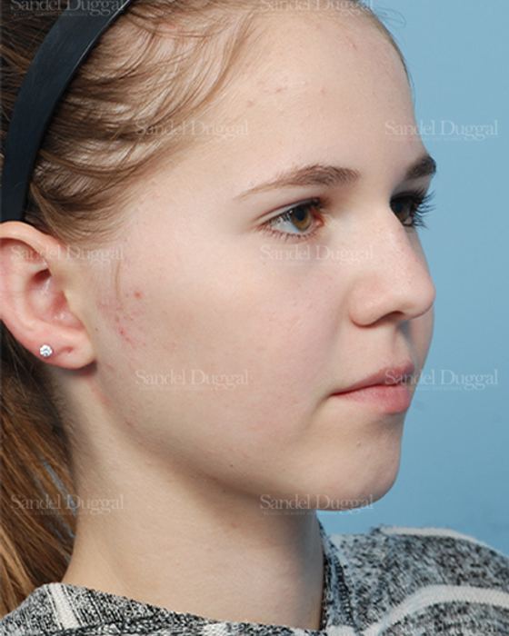 Otoplasty after, case 2598