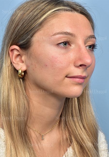 Rhinoplasty after, case 5375
