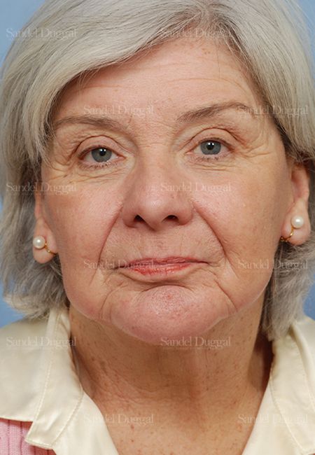 Laser Skin Resurfacing after, case 2950