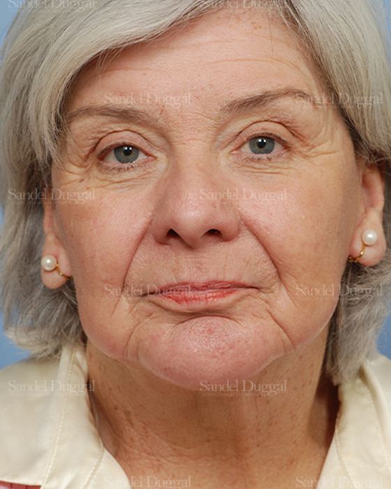 Laser Skin Resurfacing after, case 2950