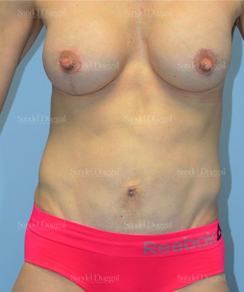 Tummy Tuck after, case 1622