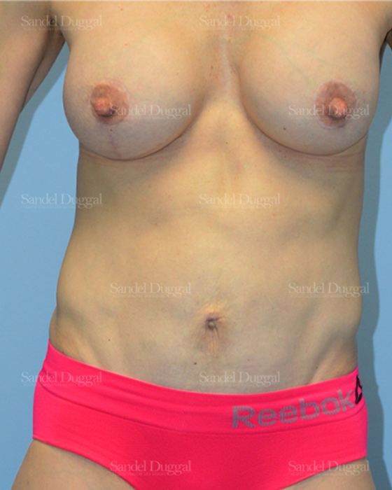 Tummy Tuck after, case 1622