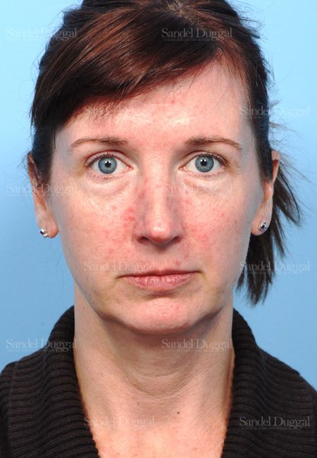 Facelift before, case 2647