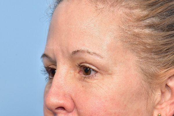 Eyelid Rejuvenation after, case 5322