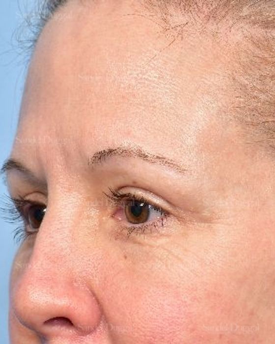 Eyelid Rejuvenation after, case 5322