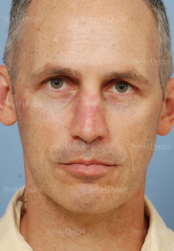 Reconstruction after Mohs after, case 2805