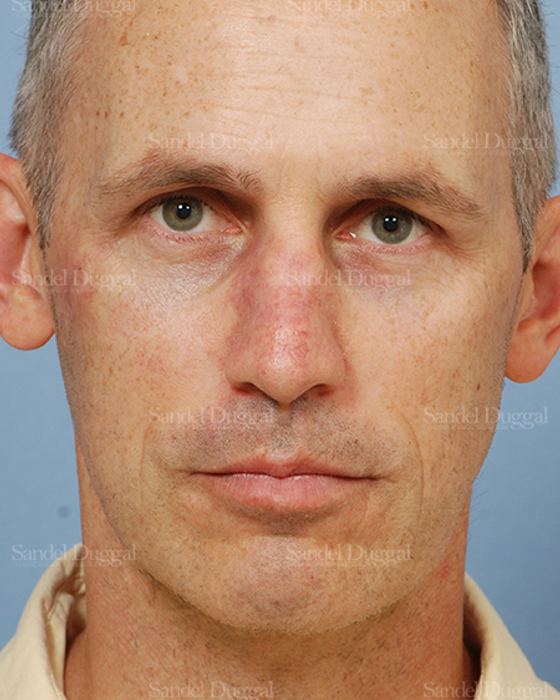 Reconstruction after Mohs after, case 2805